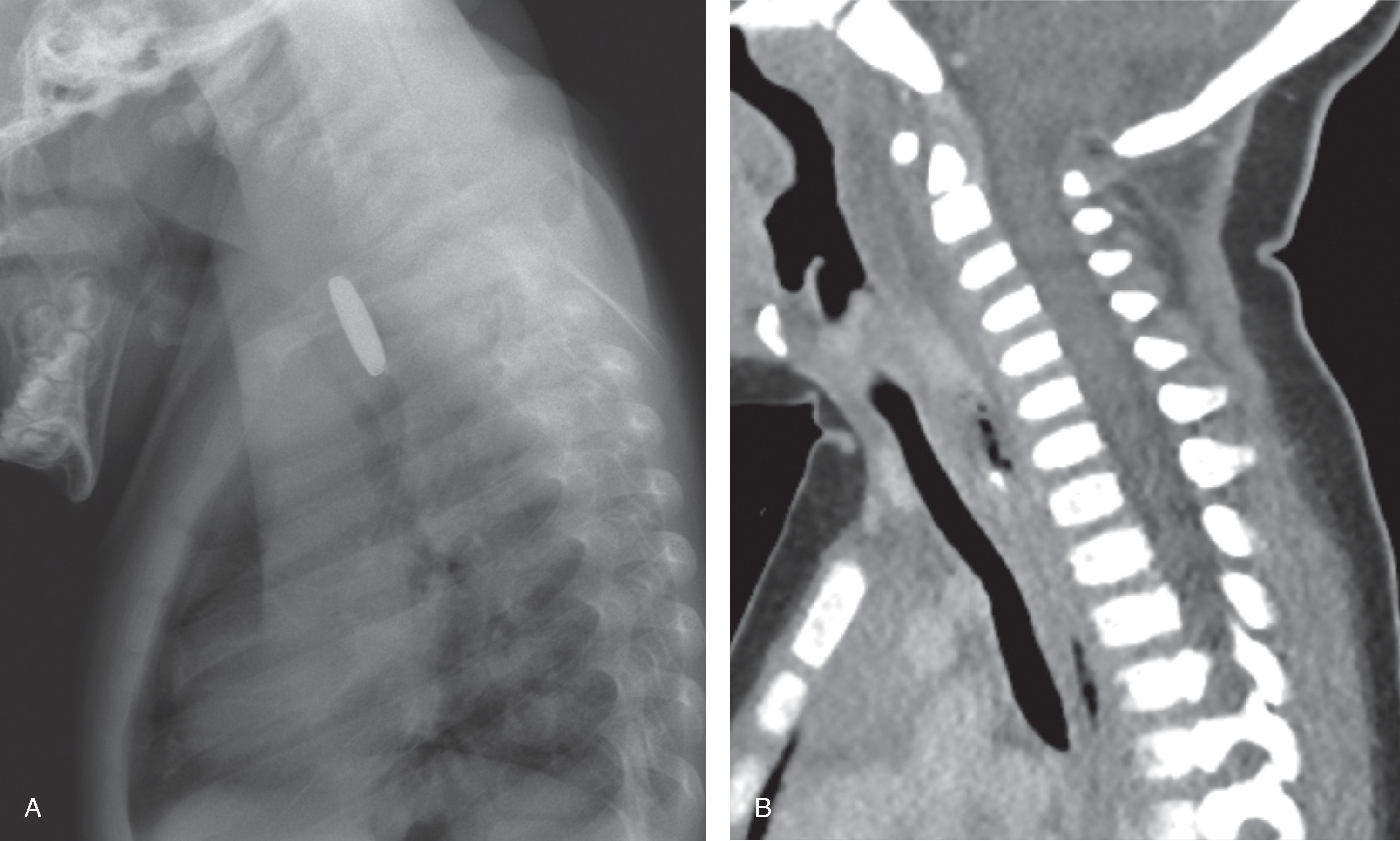 Fig. 15.10, Foreign Body Ingestion.