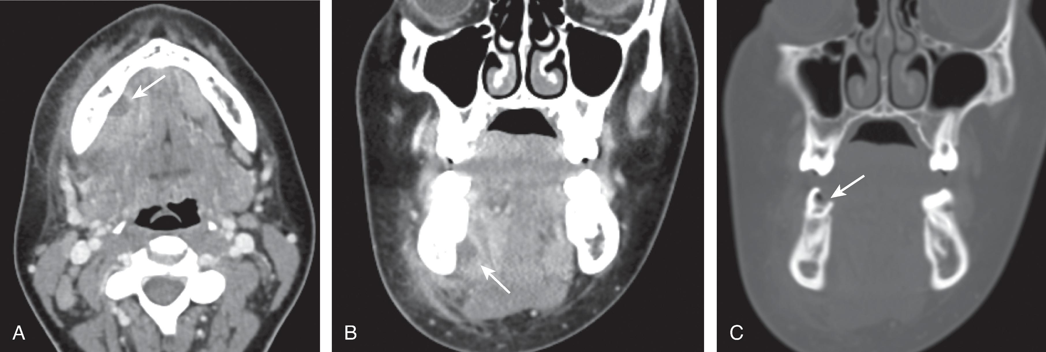 Fig. 15.11, Odontogenic Infection.