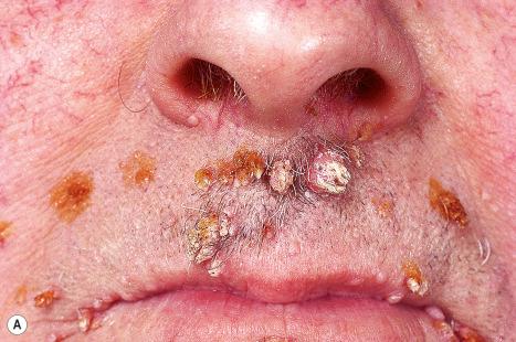 Fig. 18.1, Viral warts: ( A ) these are exceedingly common and may affect any site; ( B ) lesions are frequently multiple. ( A ) By courtesy of the Institute of Dermatology, London, UK; ( B ) By courtesy of J.C. Pascual, MD, Alicante, Spain.