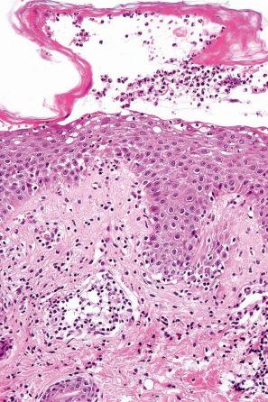 Fig. 18.103, Staphylococcal scalded skin syndrome: vesiculation occurs at the level of the granular cell layer.