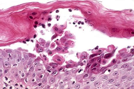 Fig. 18.104, Staphylococcal scalded skin syndrome: there is quite marked acantholysis in this example.