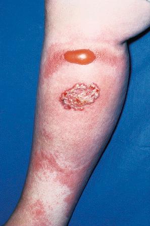 Fig. 18.107, Cellulitis: marked edema has resulted in vesiculation.