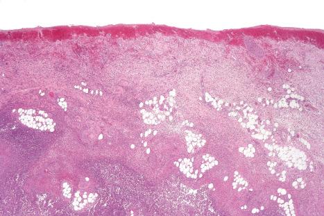 Fig. 18.109, Necrotizing fasciitis: there is intense acute inflammation of the dermis and subcutaneous fat.