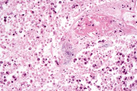 Fig. 18.111, Necrotizing fasciitis: innumerable Gram-positive cocci are present.