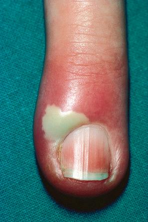 Fig. 18.116, Acute paronychia: pus and erythema are present.