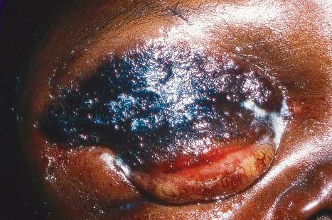 Fig. 18.120, Anthrax: cutaneous disease is the commonest manifestation in humans. This black crusted lesion is typical.