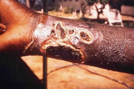 Fig. 18.121, Anthrax: multiple lesions on the forearm.
