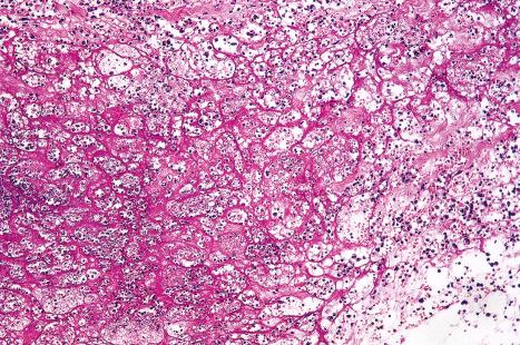 Fig. 18.123, Anthrax: marked fibrin deposition is evident.