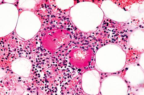 Fig. 18.124, Anthrax: thrombosed vessels are present.