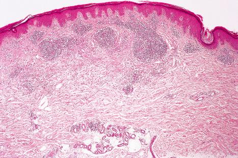 Fig. 18.126, Cat scratch disease: an irregular ill-defined focus of necrobiosis is surrounded by a nodular lymphocytic infiltrate.