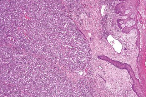 Fig. 18.132, Bacillary angiomatosis: there is a dense nodular capillary proliferative lesion; note the ectatic vessels.