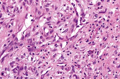 Fig. 18.133, Bacillary angiomatosis: the endothelial cells are swollen. Conspicuous neutrophils are evident.