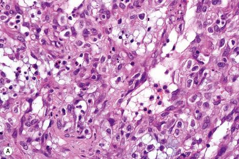 Fig. 18.134, ( A , B ) Bacillary angiomatosis: lymphocytes and histiocytes are also present. Note the purple colony of bacteria in the center of the field.