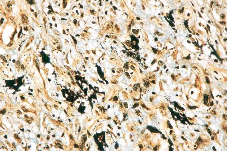 Fig. 18.135, Bacillary angiomatosis: the organisms are easily identified with the Warthin-Starry stain.