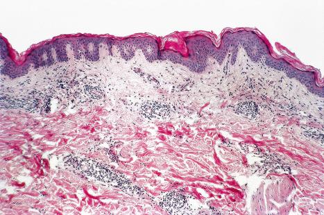 Fig. 18.137, Lyme disease: the epidermis is normal; a chronic inflammatory cell infiltrate surrounds the vessel in both the superficial and deep dermis.