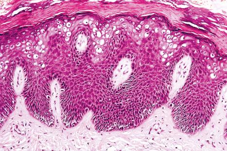 Fig. 18.18, Plane wart: there is hyperkeratosis and slight regular acanthosis; papillomatosis is only mild. Note the prominent cytoplasmic vacuolation.