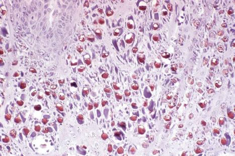 Fig. 18.2, Verruca vulgaris: note the positive labeling of the nuclei in this section stained with a peroxidase-labeled antiserum to papilloma virus.