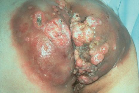 Fig. 18.24, Buschke-Löwenstein tumor: there is massive infiltration of the buttocks and perineum with numerous sinuses. HPV type 6 was identified by DNA in situ hybridization and Southern blot analysis.