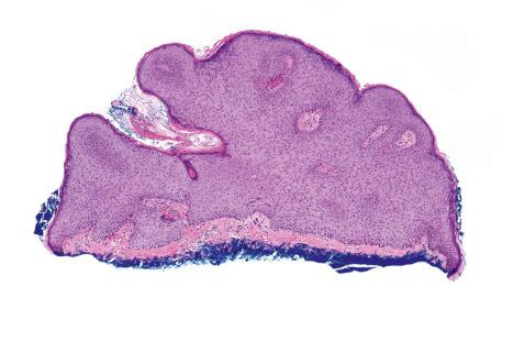 Fig. 18.25, Condyloma acuminatum: note the keratotic acanthotic epidermis with rounded lateral borders. Koilocytes are present in the declivities of the papillomatous epithelium.