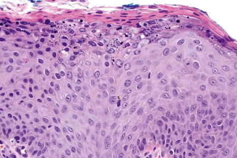 Fig. 18.26, Condyloma acuminatum: note the parakeratosis and vacuolation of the superficial keratinocytes.