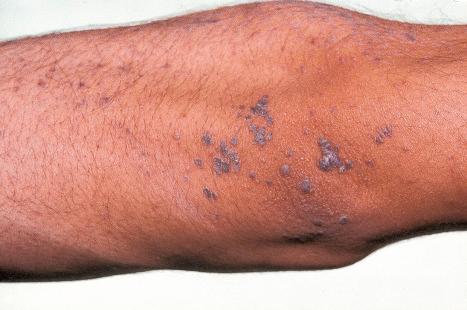 Fig. 18.28, Epidermodysplasia verruciformis: these plane warts are due to HPV3 and HPV10 infection.