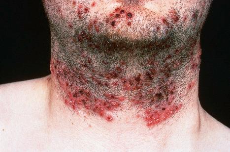 Fig. 18.36, Herpes simplex: this patient shows a particularly severe infection.