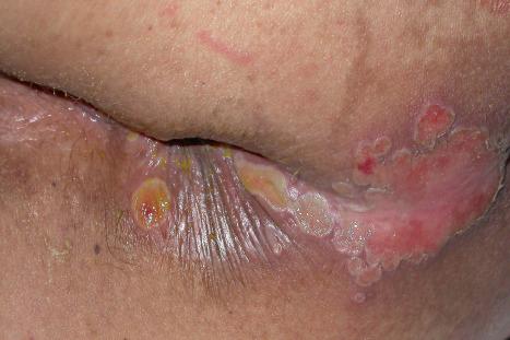 Fig. 18.38, Herpes simplex 2: in this patient there is very severe ulceration.