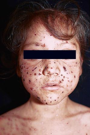 Fig. 18.41, Eczema herpeticum: this variant usually presents in atopic children. It can be a very serious condition and affect the whole body.