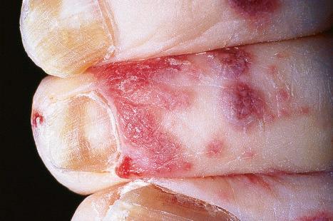 Fig. 18.42, Disseminated herpes infection: widespread lesions may be seen in immunosuppressed patients.