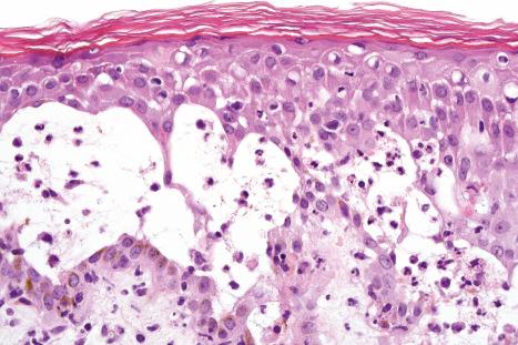 Fig. 18.43, Herpes simplex: intraepidermal vesicle in which there is intracellular edema (ballooning degeneration) and acantholysis.