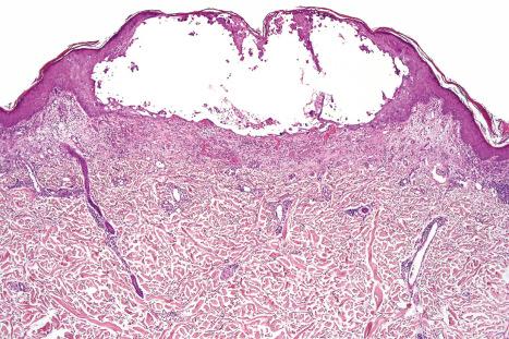 Fig. 18.44, Herpes simplex: scanning view of intact intraepidermal blister.