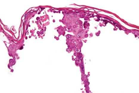 Fig. 18.45, Herpes simplex: the roof shows acantholysis and scattered characteristic intranuclear inclusions.