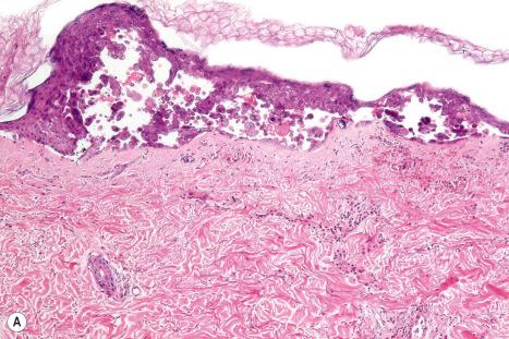 Fig. 18.46, ( A, B ) Herpes simplex: note the numerous multinucleate giant cells and conspicuous pale-staining inclusions ( B ).