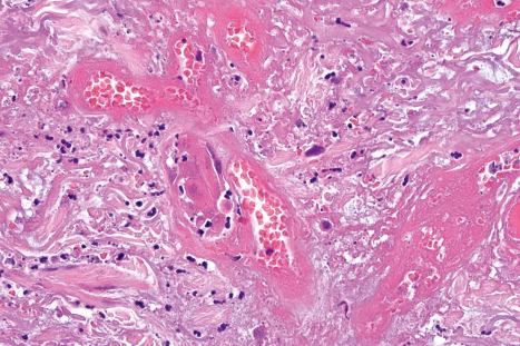 Fig. 18.48, Herpes simplex: multiple vessels show intense fibrinoid necrosis.