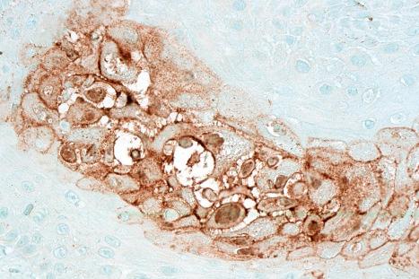 Fig. 18.49, Herpes simplex: positive immunohistochemistry.