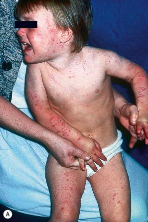 Fig. 18.50, Varicella (chickenpox): ( A ) note the widespread distribution of vesicles on the face, upper chest, arms, and legs; ( B ) close-up view. ( A ) By courtesy of R.A. Marsden, MD, St George's Hospital, London, UK; ( B ) by courtesy of the Institute of Dermatology, London, UK.