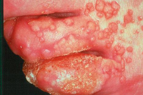 Fig. 18.5, Verruca vulgaris: presentation with such large numbers of lesions raises the possibility of immunosuppression.