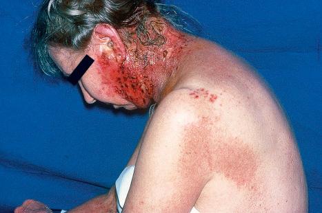 Fig. 18.53, Herpes zoster (shingles): older lesion in which the rash has a hemorrhagic component.