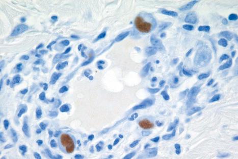 Fig. 18.58, Cytomegalovirus: positive immunohistochemistry.