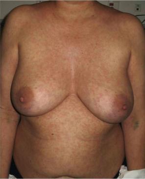 Fig. 18.59, Measles: erythematous maculopapular skin rash. The rash is usually characterized by cephalocaudal progression.