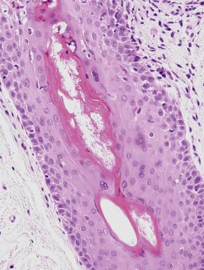 Fig. 18.60, Measles: multinucleate follicular keratinocytes (polykarions/grape cells) are present, and these serve as a clue to the diagnosis.