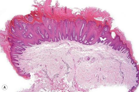 Fig. 18.6, Verruca vulgaris: ( A ) note the hyperkeratosis and papillomatosis; ( B ) there is often marked parakeratosis typically arranged as a vertical tier. Koilocytes are conspicuous.