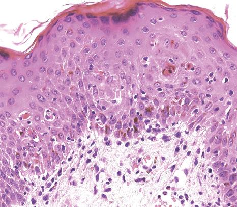 Fig. 18.61, Measles: numerous individual necrotic keratinocytes at the opening of the hair follicle into the epidermis.