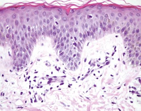 Fig. 18.62, Eruptive pseudoangiomatosis: the histologic findings are subtle, with superficial dermal vascular ectasia and relative prominence of the endothelial cells.