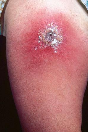 Fig. 18.64, Vaccinia: due to the eradication of smallpox, routine vaccination is no longer performed. Note the eschar, edema, and intense erythema.