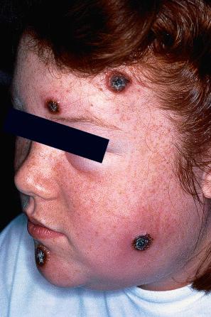 Fig. 18.65, Cowpox: characteristic umbilicated, ulcerated nodules. Lesions are often multiple.