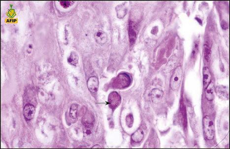 Fig. 18.67, Variola (smallpox): high-power view showing Guarneri bodies ( arrowed ).