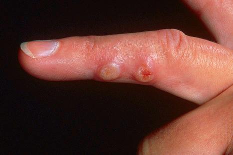 Fig. 18.68, Milker nodule: the blister roof has an opaque appearance and there is surrounding erythema.