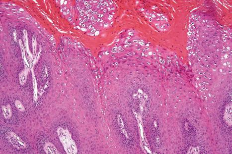 Fig. 18.7, Verruca vulgaris: large vacuolated cells with enlarged and irregular keratohyalin granules are characteristic.