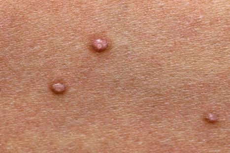 Fig. 18.77, Molluscum contagiosum: multiple umbilicated lesions are present.